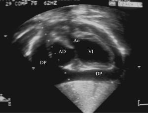 Ecocardiograma transtorácico que muestra un derrame pericárdico moderado-severo (DP) sin signos establecidos de taponamiento cardiaco. AD: aurícula derecha; VI: ventrículo izquierdo; Ao: aorta.