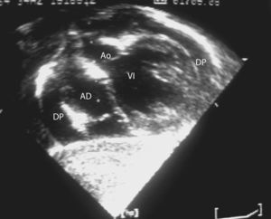 Ecocardiograma tras tratamiento hormonal sustitutivo con derrame pericárdico (DP) leve sin signos de compromiso hemodinámico. AD: aurícula derecha; VI: ventrículo izquierdo; Ao: aorta.
