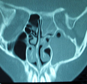 Corte coronal de TC en el que se observa la pansinusitis izquierda con obstrucción del complejo osteomeatal.