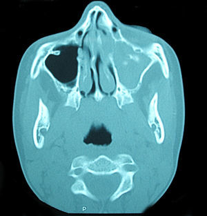 Corte axial de TC en el que se observa la ocupación completa del seno maxilar izquierdo por una masa que contiene distintas radiodensidades.