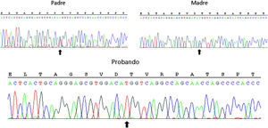 Secuenciación directa del gen CYP11B2 en el paciente y ambos progenitores. Las flechas indician la mutación c.953C>G, que se encuentra en homocigosis en el probando y en heterocigosis en ambos pardes.