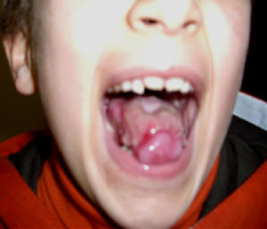 Joven con DC: leucoplasia oral.