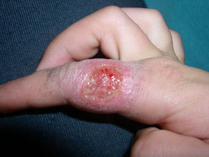 Leishmaniasis cutánea por Leishmania braziliensis antes del tratamiento.