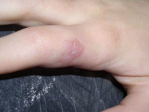 Leishmaniasis cutánea por Leishmania braziliensis tras el tratamiento con anfotericina B liposomal.