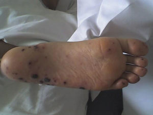 Lesiones purpúricas en pie izquierdo.