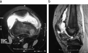 Resonancia magnética en secuencia T2. a) corte axial. b) corte sagital.
