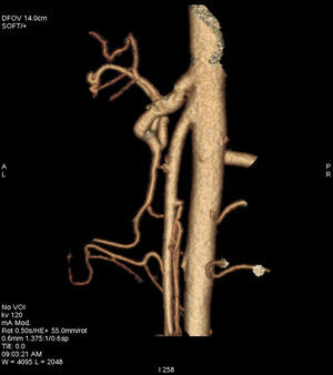 Angio-TC abdominal: reconstrucción en 3D en la que se puede observar una angulación excesivamente aguda, de 19°, entre la arteria aorta y la arteria mesentérica superior.