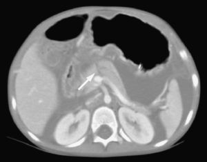 Tomografía computarizada abdominal. Imagen de fractura pancreática a la altura de la unión entre la cabeza y el cuerpo del páncreas.