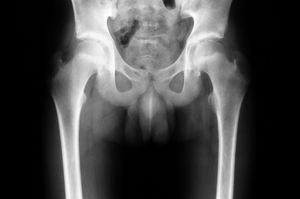 Radiografía antero-posterior de cadera. No se observa patología a nivel de la articulación coxofemoral.