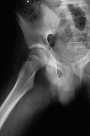 Radiografía axial de cadera. Observe el arrancamiento de la espina iliaca antero-inferior derecha.