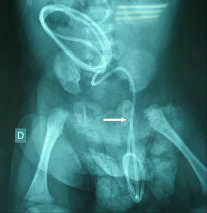 Radiografía de abdomen: se observa parte del catéter distal a nivel escrotal aunque la punta del catéter está intrabdominal (flecha).