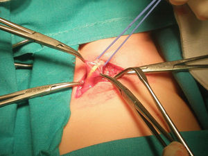 Fotografía intraoperatoria en la que se aprecia el catéter peritoneal dentro de la hernia inguinal congénita.