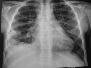 Radiografía de Tórax. Destaca discreta cardiomegalia intuyéndose las calcificaciones en surco AV. Condensación a nivel de lóbulos medio e inferior derecho con derrame pleural asociado.