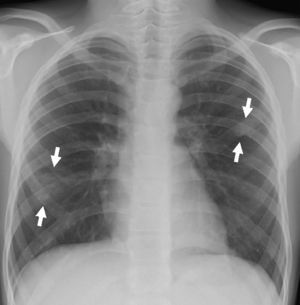 Flechas mostrando imágenes nodulares redondeadas en ambos campos pulmonares.