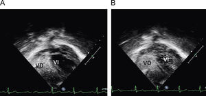Ecocardiograma 2D en proyección subcostal tras administración de suero salino agitado por vía iv. A) Aparición de contraste en cavidades derechas. B) Reaparición de contraste en cavidades izquierdas al cabo de 4–5 ciclos.