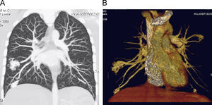 AngioTC torácico. A) Reconstrucción de máxima intensidad de proyección (MIP) coronal. B) Reconstrucción volumétrica, que muestra imágenes nodulares en ambos pulmones, correspondientes a fístulas arteriovenosas pulmonares.