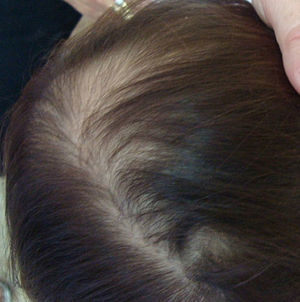 Fragilidad y escasez capilar en área centroparietal, sin otras alteraciones del cuero cabelludo.