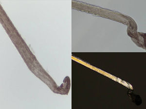 A, B) Tricograma: pelos terminales en fase anágena con morfología de bulbo en maza y cutícula de morfología espiroidea. C) La luz polarizada resalta la cutícula «en sacacorchos» sin observarse otras alteraciones.