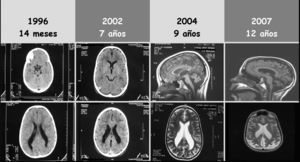Evolución de la neuroimagen. TC con 14 meses y 7 años compatible con leucomalacia periventricular. RM con 9 y 12 años con atrofia cerebelosa y supratentorial de predominio posterior.