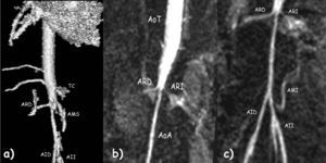 Angio resonancia magnética: a) Hipoplasia de aorta abdominal por debajo de arteria mesentérica superior (AMS) y tronco celíaco (TC) y que afecta la salida de ambas arterias renales (ARD, arteria renal derecha). Disminución del tamaño de ambas arterias iliacas, derecha (AID) e izquierda (AII). b y c) Aorta torácica (AoT) normal con severa coartación inframesentérica que afecta la salida de ambas arterias renales. Aorta abdominal (AoA). La arteria mesentérica (AMI) inferior normal.