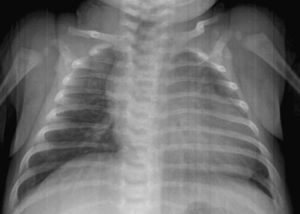 Radiografía de tórax en unidad de cuidados intensivos en la que se aprecia cardiomegalia (indice cardiotorácico=0,7) y congestión pulmonar.