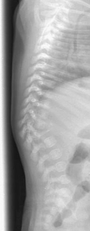 Cifoescoliosis con desaparición casi total del cuerpo vertebral de L1 en radiografía de columna vertebral.