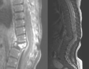 Aplastamiento vertebral de L1 con protrusión posterior, cifosis y cambios circundantes en RM de columna vertebral.
