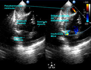 Ecocardiografía 2D-Doppler color. Proyección 4 cámaras. Se evidencia pseudoaneurisma situado posteriormente al ventrículo izquierdo con importante hematoma en su interior y flujo en sístole desde el interior de VI al PS. Se aprecia compresión del VI por la lesión que provocaba insuficiencia mitral.
