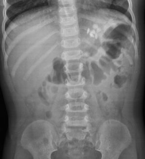 Radiografía abdominal que muestra comprimidos radioopacos en cámara gástrica.