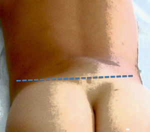 Línea teórica de separación del seno sacrocoxígeo y del seno dérmico auténtico.