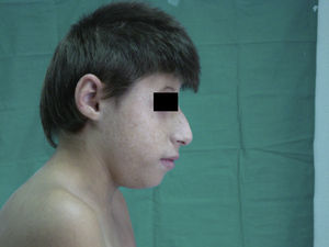 Características faciales del paciente típicas del síndrome de Nijmegen. Se observan efélides.
