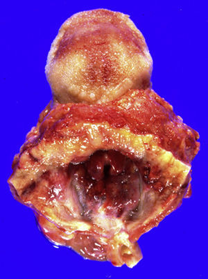 Epiglotis de color rojo cereza (vista craneal).