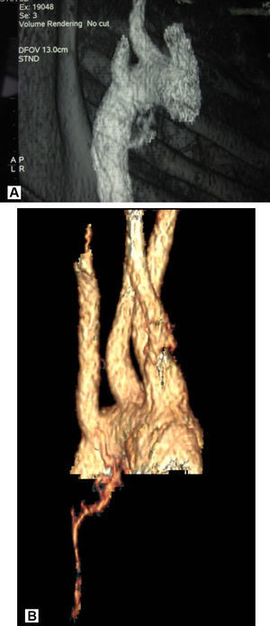 Reconstrucción de la tomografía computarizada: arteria bronquial derecha hipertrofiada y aberrante con origen en aorta adyacente a subclavia derecha aberrante. Visión posterior.