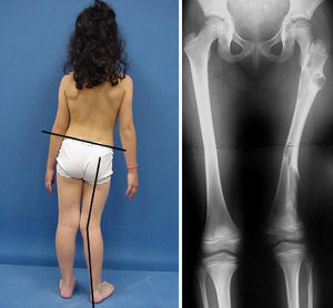 Niña de ocho años, afecta de encondromatosis en fémur proximal y distal y también en peroné. La dismetría secundaria ha provocado una escoliosis, motivo por el cual se diagnosticó la enfermedad.
