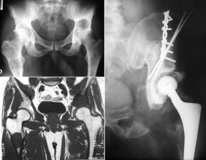 Paciente de 44 años, previamente asintomático. El dolor en la cadera izquierda llevó al diagnóstico de encondromatosis (observamos además lesiones en la cadera contralateral y en un hombro) con malignización de la localización pélvica. El tratamiento de ésta fue la resección en bloque y la reconstrucción con aloinjerto y prótesis. Nueve años después, el paciente está libre de enfermedad.