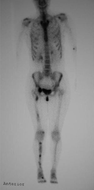 La gammagrafía ósea se ha mostrado muy útil para detectar lesiones múltiples asintomáticas. En la imagen observamos múltiples lesiones hipercaptantes, encondromas, en extremidad inferior derecha.