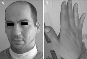 Padre de la paciente. A) Aspecto facial. B) Primer dedo grande y ancho.