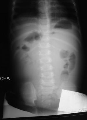 Radiografía de abdomen (silencio abdominal inferior con efecto masa y desplazamiento lateral y craneal de asas intestinales).