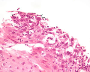 Mucosa esofágica con alteraciones citopáticas congruentes con infección por virus herpes.