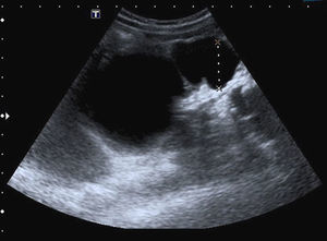 Imagen ecográfica del riñón izquierdo sustituido por dos formaciones quísticas.