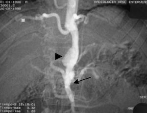 Dilatación aneurismática (punta de flecha) por encima de la salida del TC. Interrupción de la aorta abdominal por debajo de la salida de la AMS (flecha).