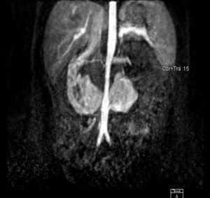 Presencia de riñones en herradura con pedículos renales bajos. Estenosis aórtica por debajo de la salida de la AMS.