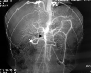 Interrupción de la aorta abdominal (flecha negra) a la salida de la AMS. Arterias renales a través del arco de Riolano (flecha blanca). Gran tortuosidad de arterias intercostales.