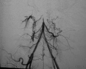Reperfusión de aorta distal cerca de la bifurcación de la iliaca a través de colaterales.