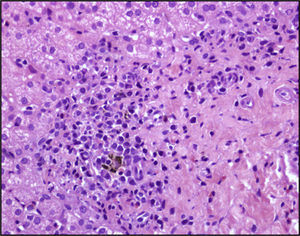 Tinción inmunohistoquímica hepática que muestra infiltración portal por células redondas linfoplasmocitarias y por eosinófilos con nódulos de regeneración y pigmento malárico.