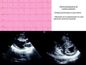 Imagen de ECG. Imágenes de ecocardiografía-Doppler en planos paraesternal eje largo y corto en los que se aprecia el marcado engrosamiento septal.