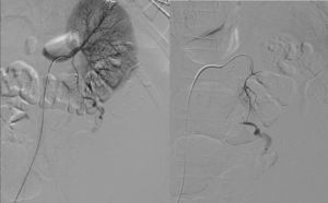 La angiografía selectiva de la arteria renal izquierda muestra la extravasación de la solución de contraste.