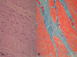 A) Hematoxilina-eosina; cambios degenerativos en la capa muscular lisa (miocitólisis y picnosis). B) Tricrómico de Masson; gruesas bandas de tejido conectivo fibroso entre las fibras musculares lisas.