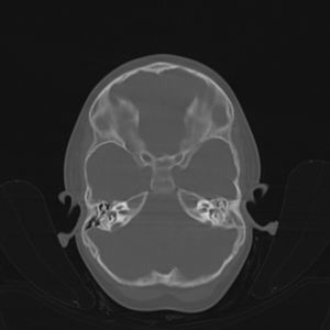 Imagen de TC craneal del caso 2. Se observa ocupación de la caja timpánica, aditus, antro mastoideo y celdas mastoideas.