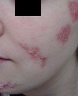 En esta imagen, tomada dos meses después de iniciarse el cuadro cutáneo, se aprecian unas llamativas cicatrices hipertróficas como resultado del intenso daño infringido en la piel.